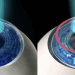 What Is The True Difference Between PRK And LASIK?